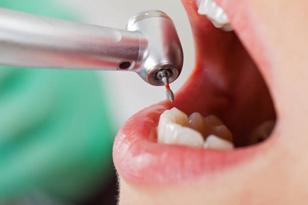 Best Emergency Tooth Extraction in Charlotte, NC